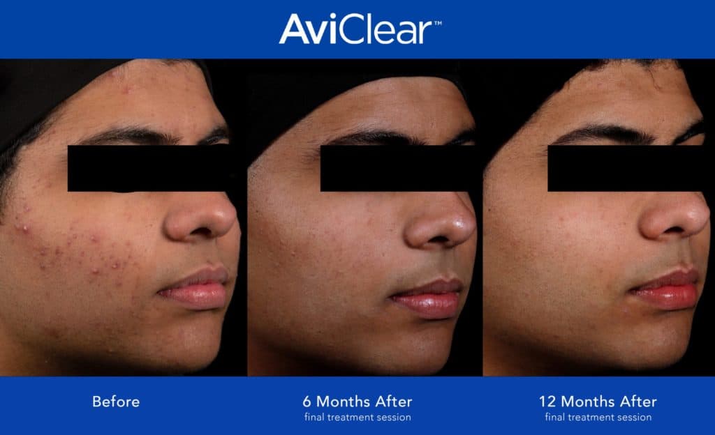 AviClear Acne Treatment