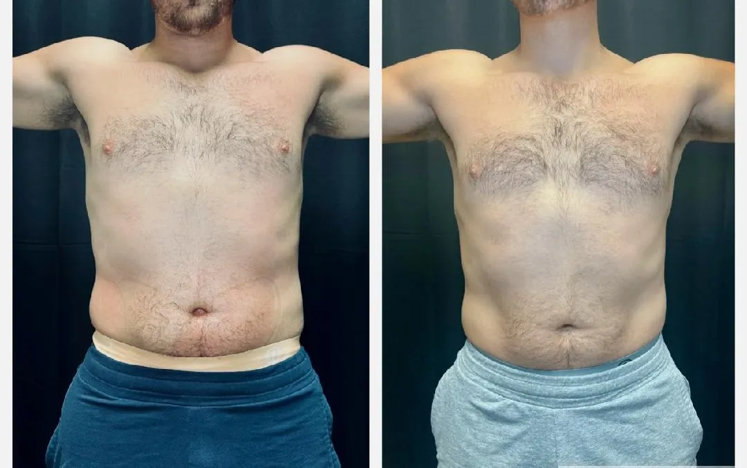Coolsculpting Before & AFter (2)