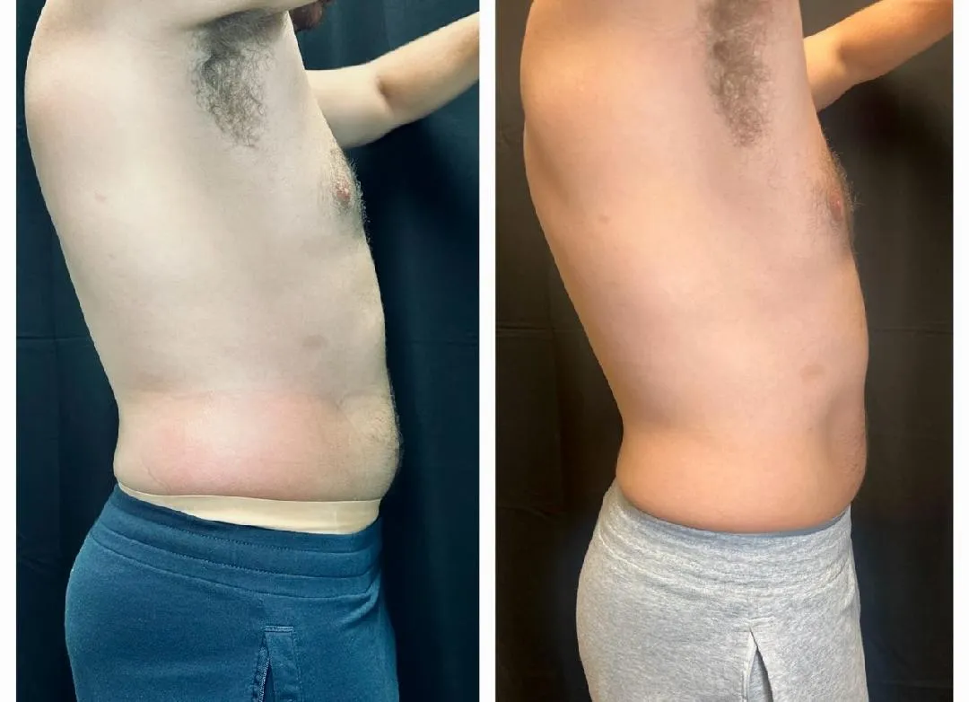 Coolsculpting Before & After (3)