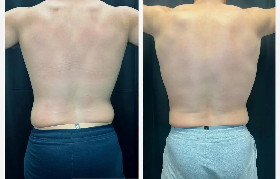 Coolsculpting Before & After (4)