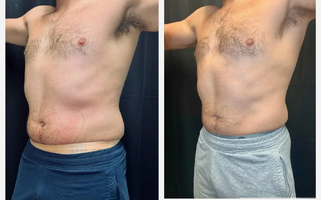 Coolsculpting Before & After (5)