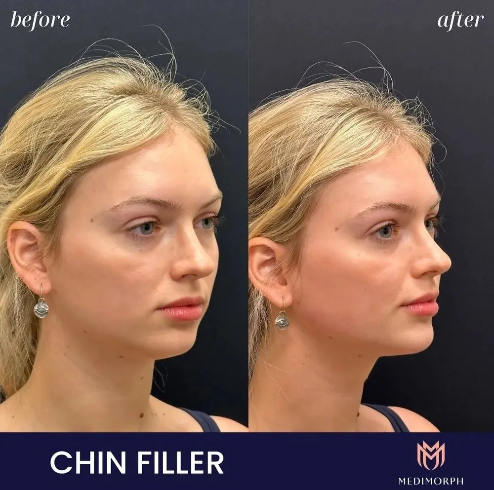 Facial Balancing - Chin Filler