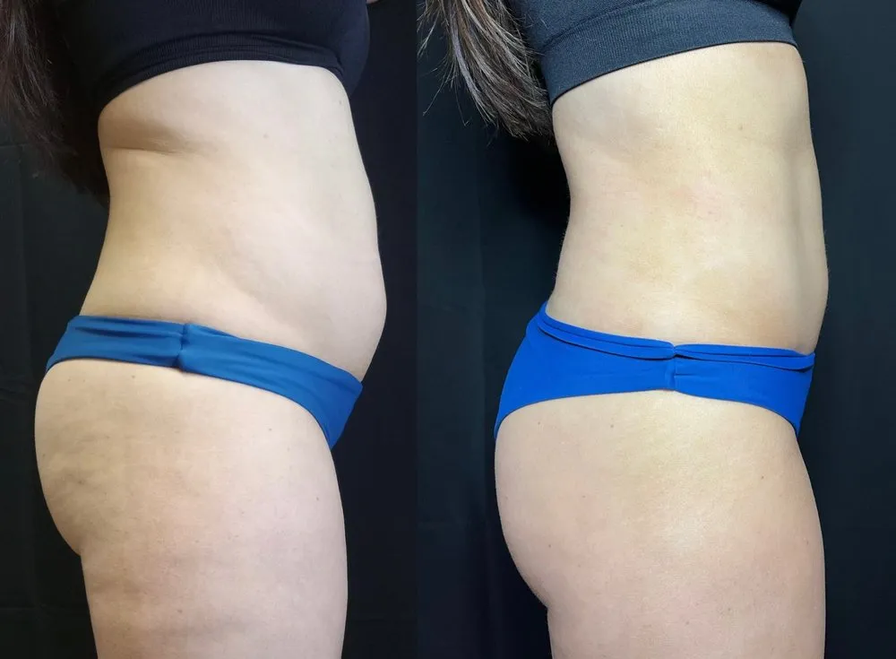 Total Body Transformation With Hormone Replacement & Emsculpt